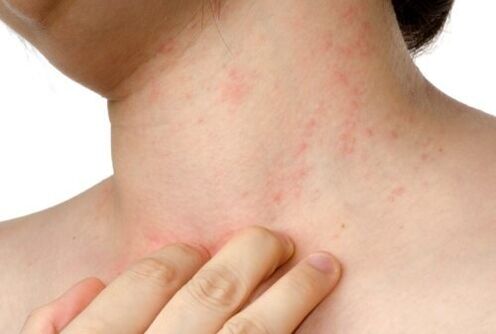 allergic to parasites under the skin