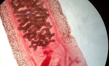 Anquilostomosis in humans