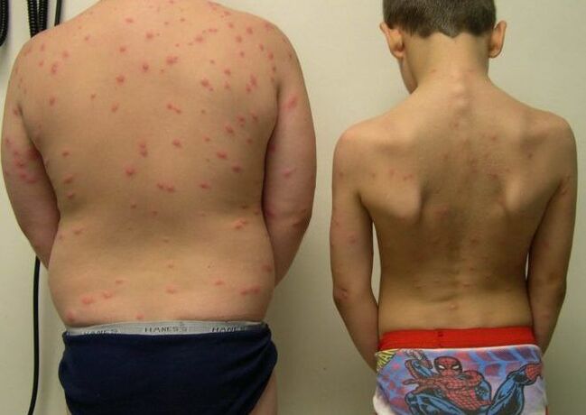 The rash on the skin with worms