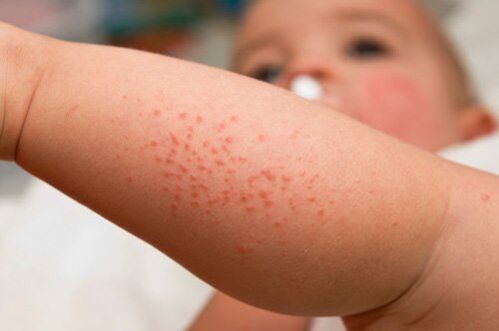 Allergies in children are a symptom of the presence of worms