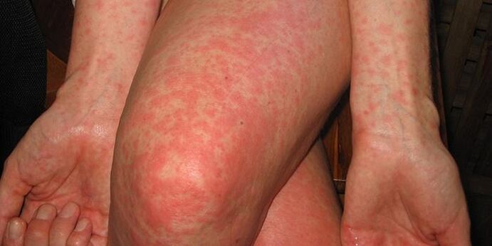Symptoms of parasites in the body